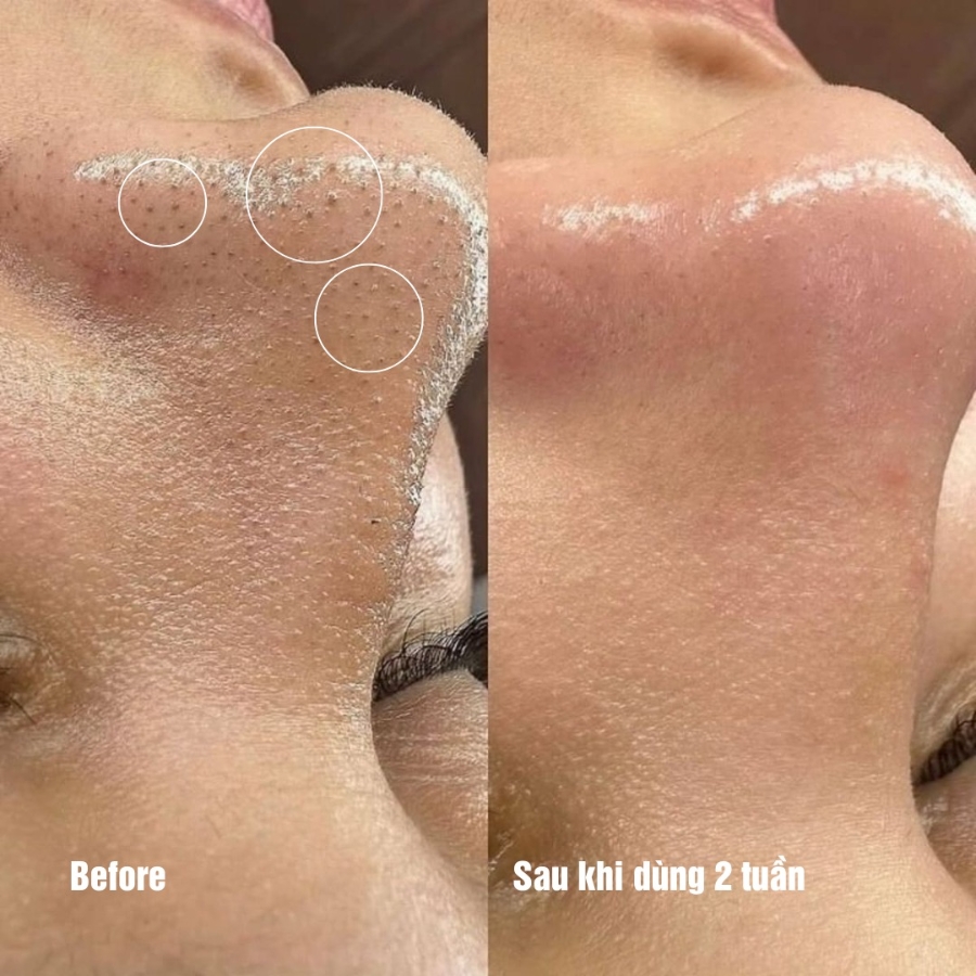 The iLLON 10 Minute Mask
