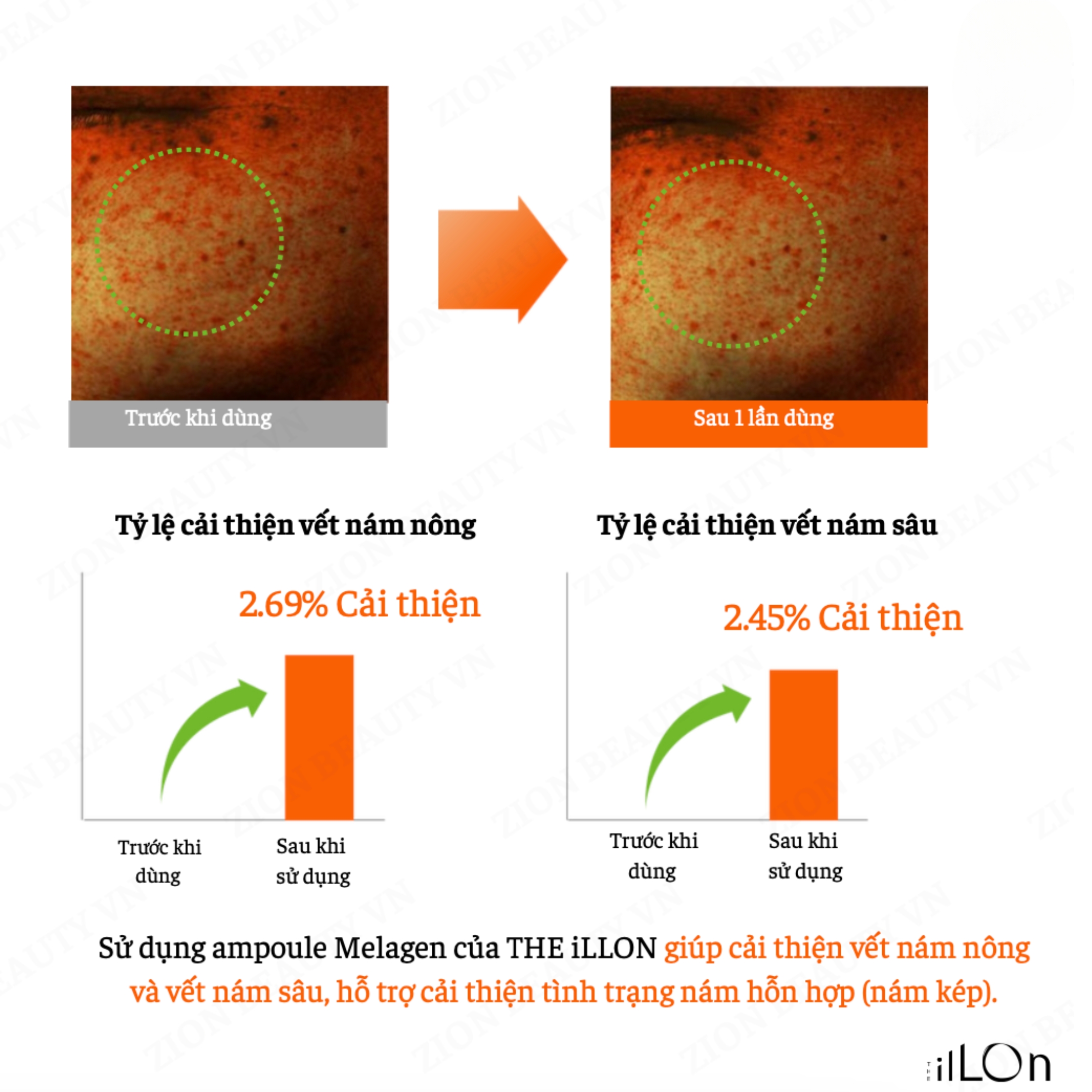 Serum Dưỡng Da Cải Thiện Sắc Tố Da – The ilLon Melagen Ampoule